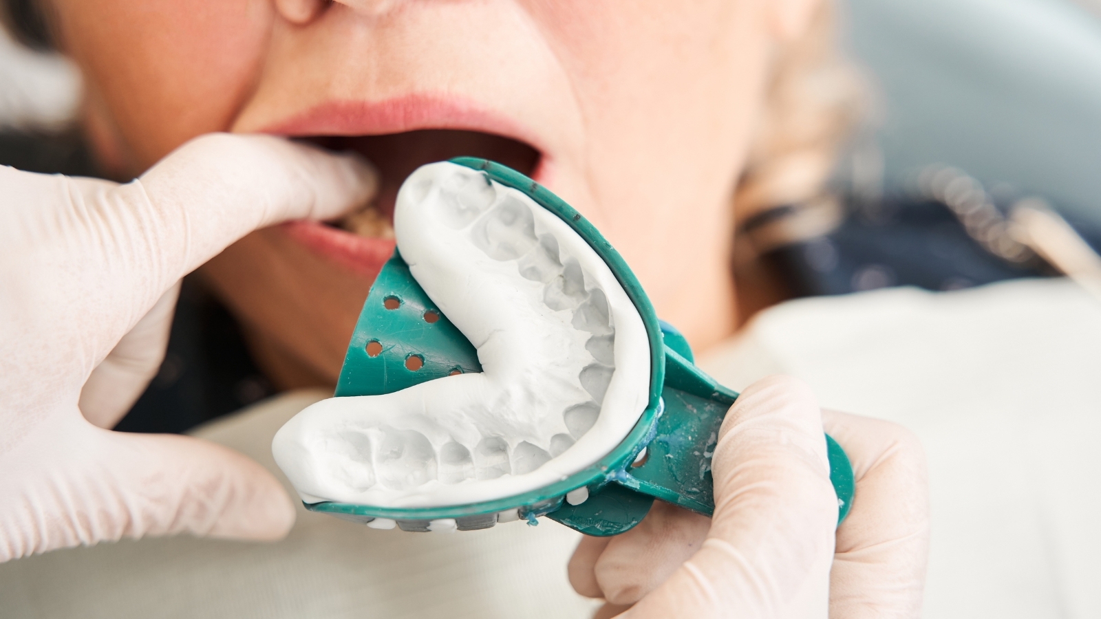 歯医者　型取り　値段