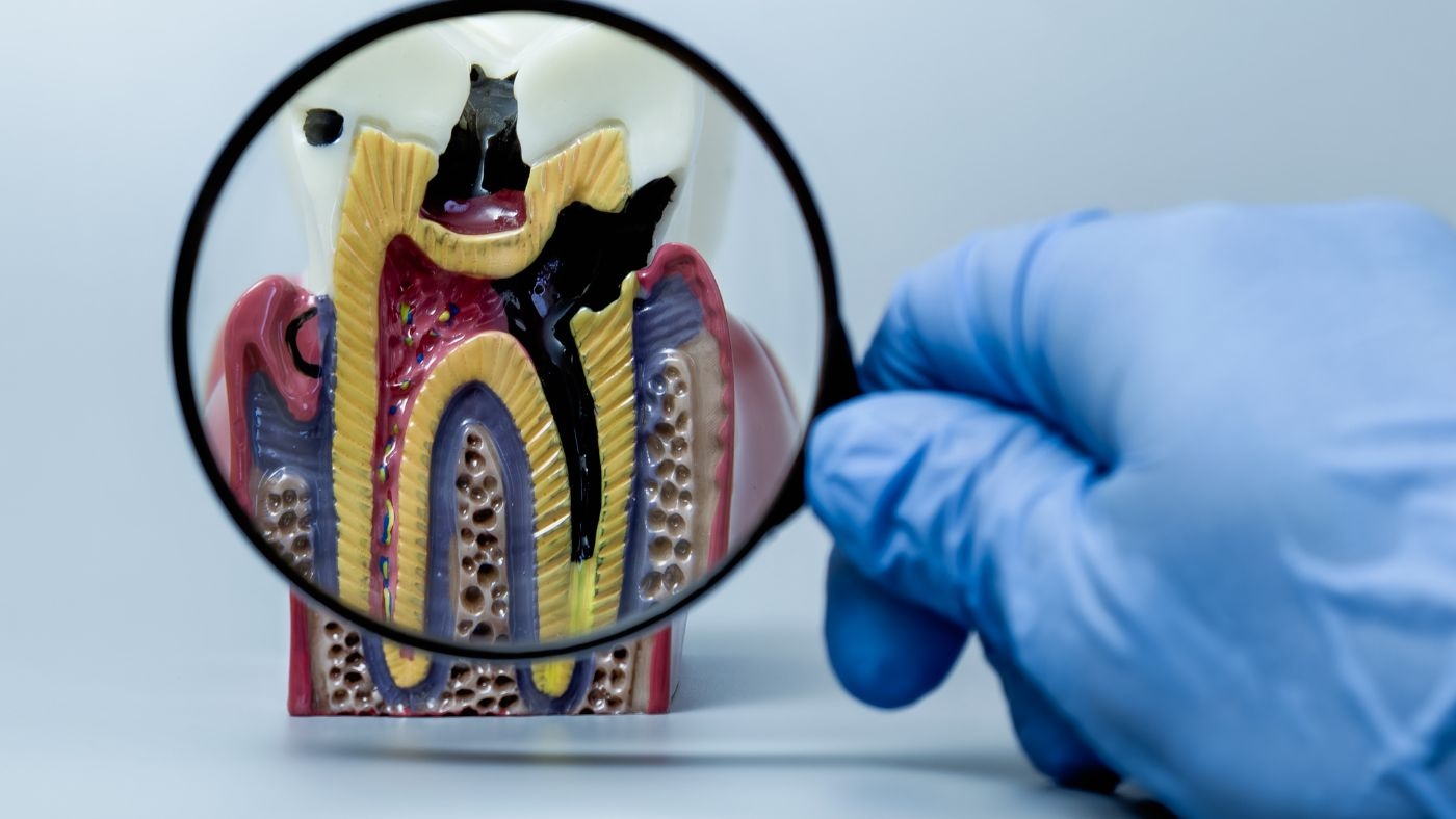 歯医者　根幹治療　費用