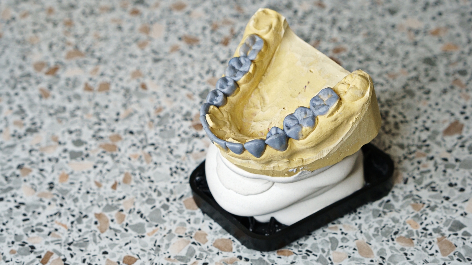 歯医者　型取り　値段