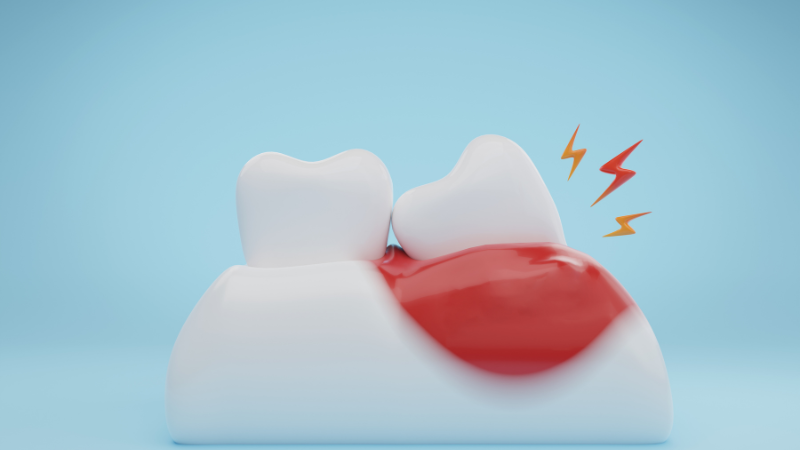 歯茎が腫れる原因と治し方