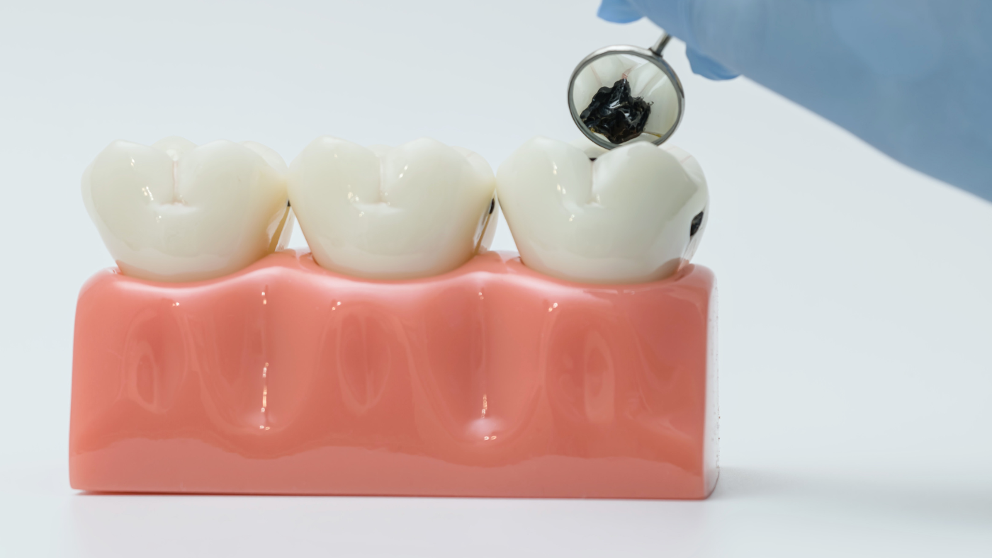 歯医者 虫歯 値段