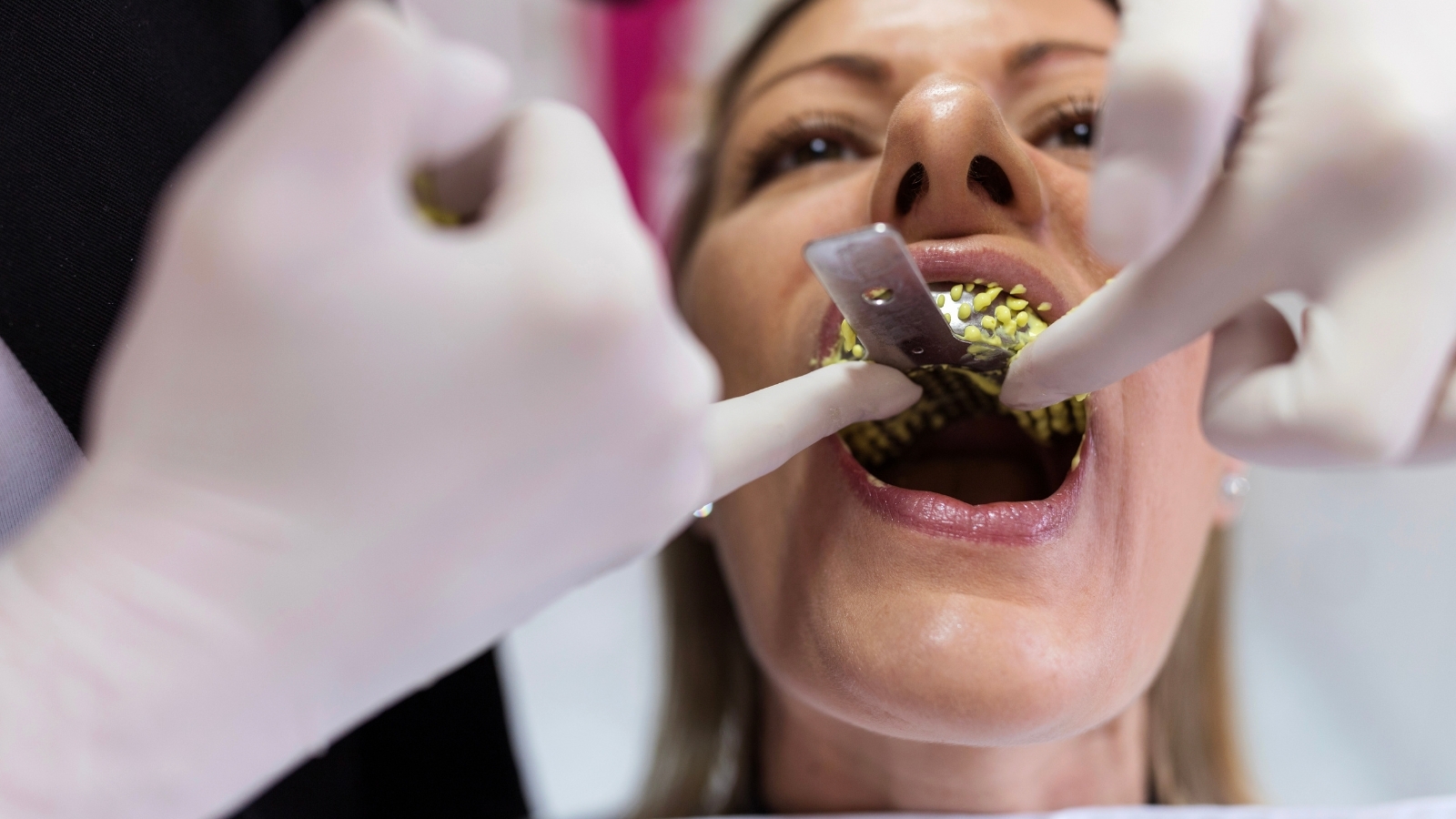 歯医者　型取り　値段