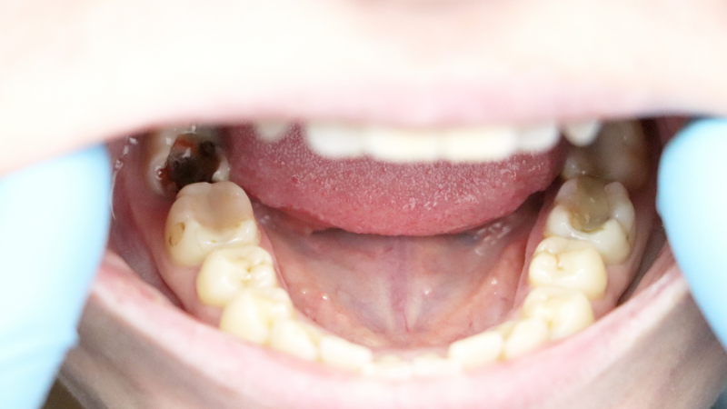 歯茎が腫れる原因と治し方