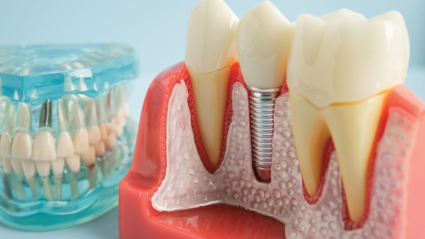 歯医者　根幹治療　費用