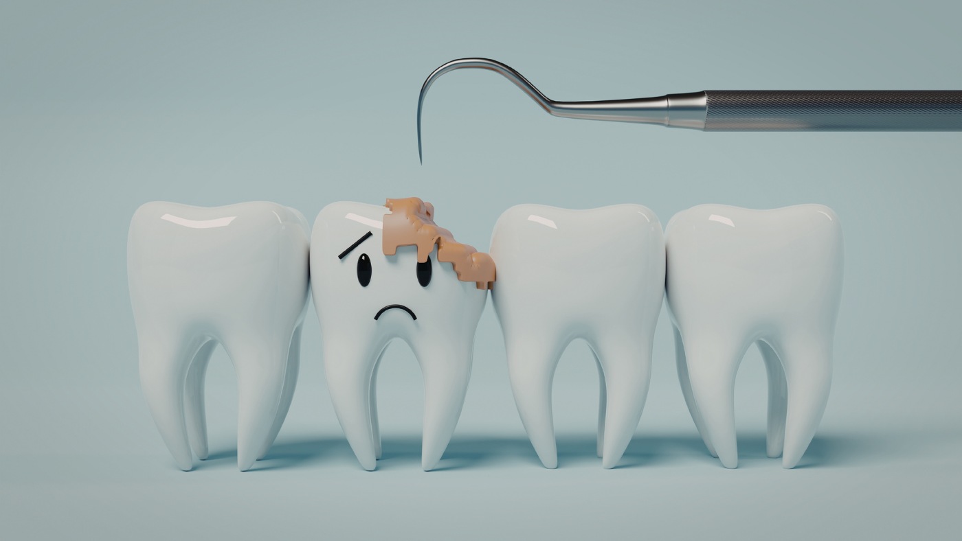 歯医者 虫歯 値段