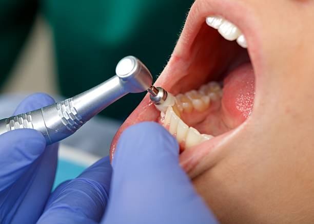 歯医者　クリーニング　頻度